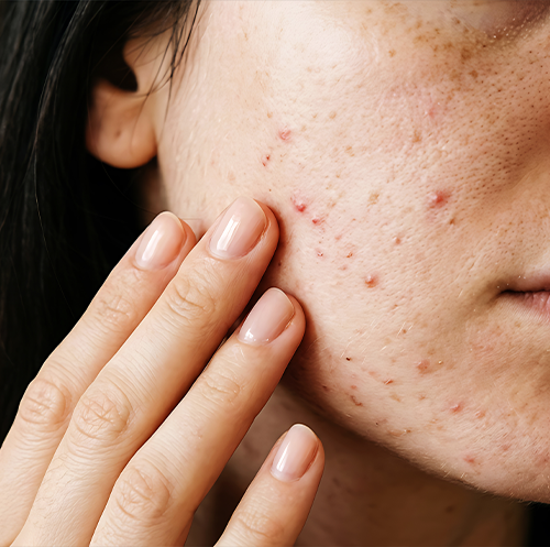 ITX - Acne Reset